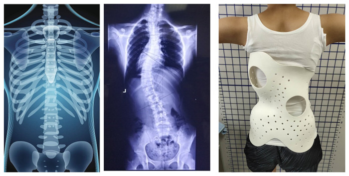 Sls 3d Printing For Healthcare Custom Prosthetics And Medical Devices